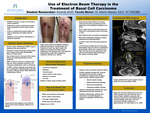 Use of Electron Beam Therapy in the Treatment of Basal Cell Carcinoma