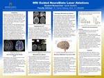 MRI Guided NeuroBlate Laser Ablations