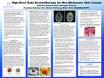 High-Dose Rate Brachytherapy for Non-Melanoma Skin Cancer