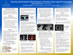 Detection and Treatment of Bronchogenic Carcinoma Using Computed Tomography