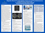 Magnetic Resonance Neuroblate Fusion for Treating Glioblastomas by Amanda Goldy