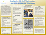 Embolization of Brain AV Malformations by Ashleigh M. Button